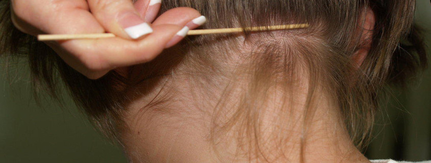 head-lice-removal-san-diego
