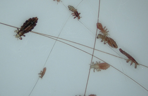 head-lice-removal-san-diego